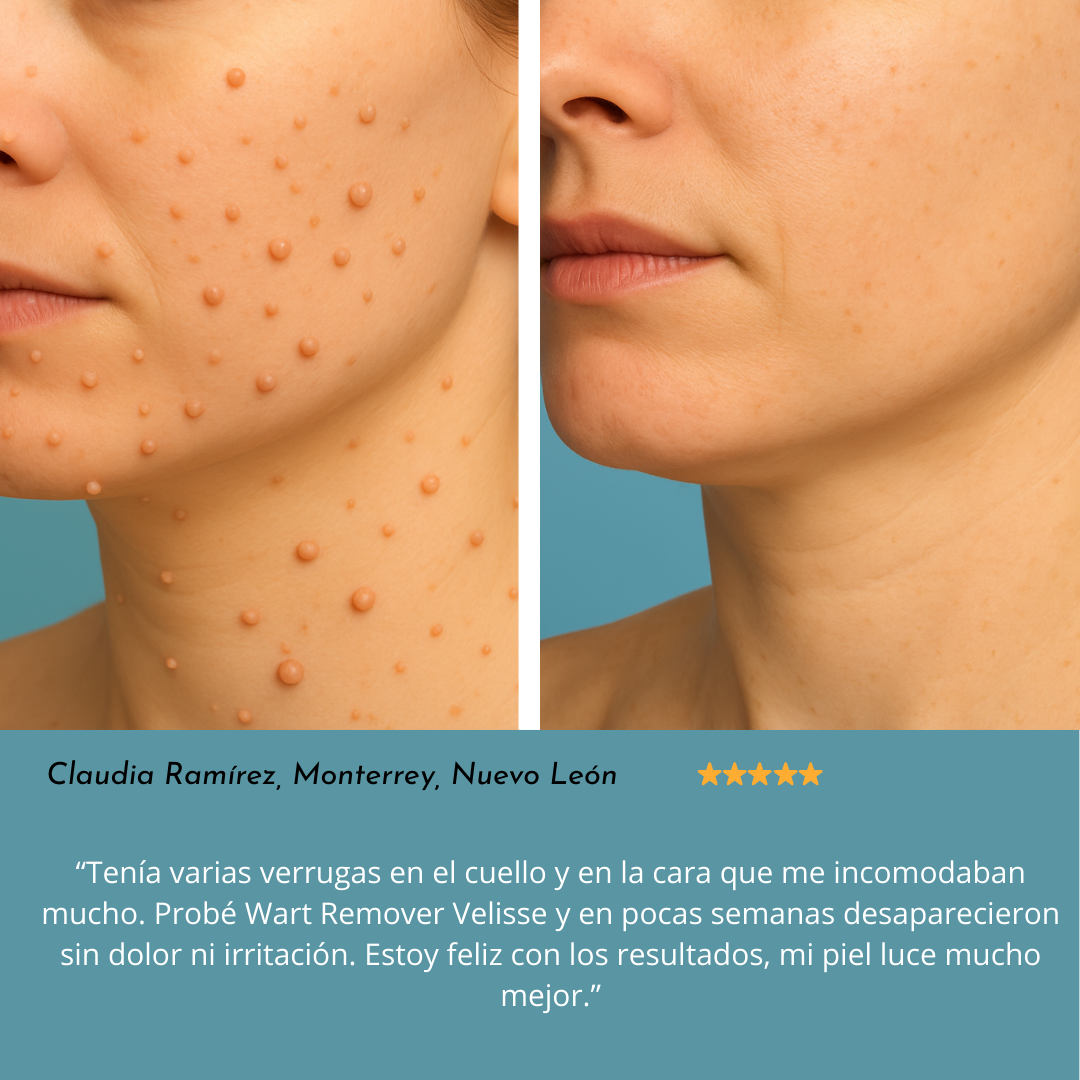 Wart Remover® : Adiós a lo que sobra, resalta tu belleza