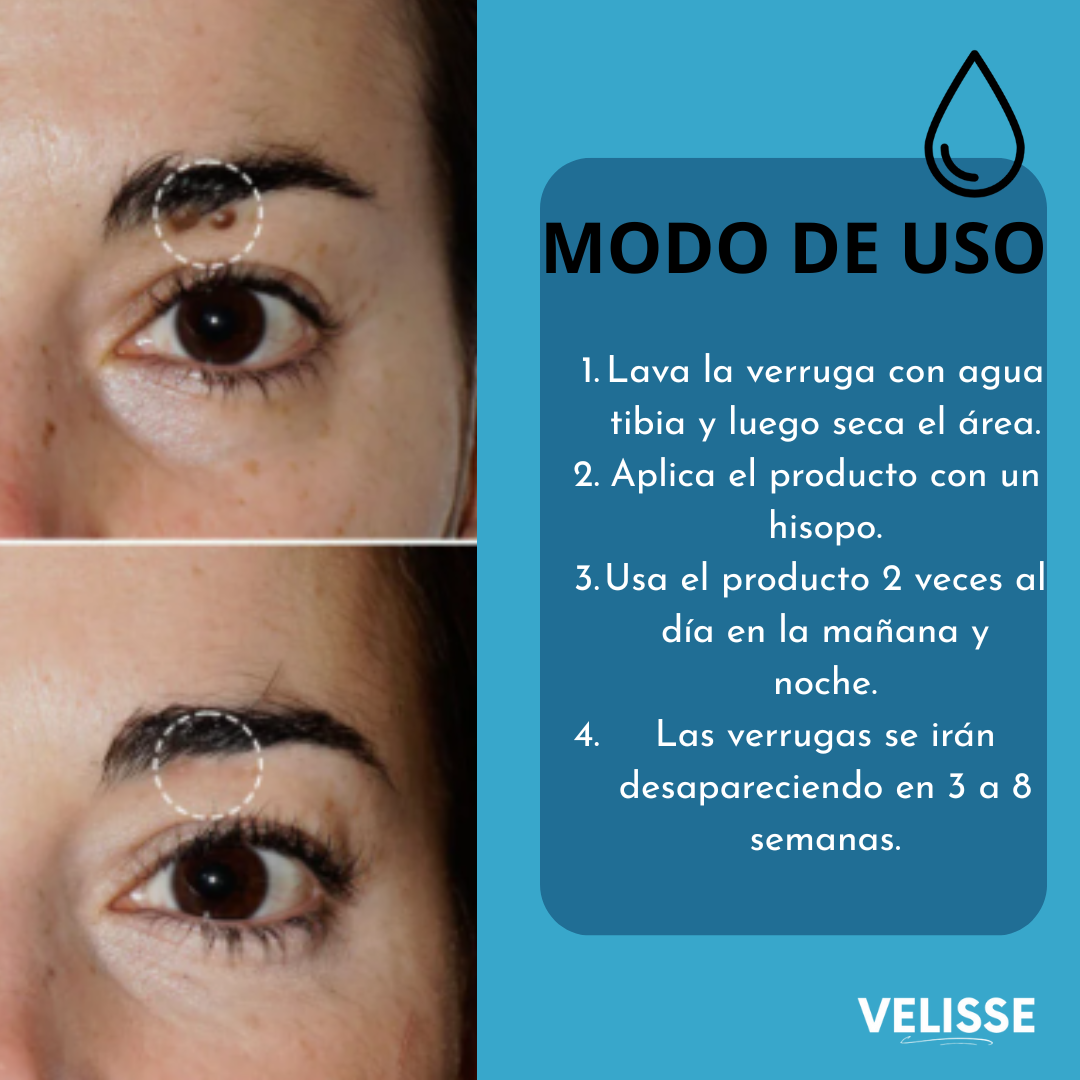 Wart Remover® : Adiós a lo que sobra, resalta tu belleza