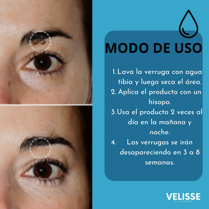 Wart Remover® : Adiós a lo que sobra, resalta tu belleza