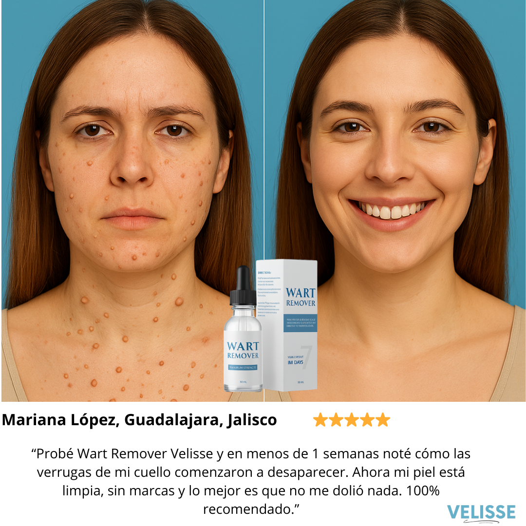 Wart Remover® : Adiós a lo que sobra, resalta tu belleza