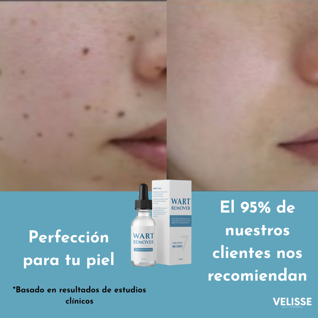Wart Remover® : Adiós a lo que sobra, resalta tu belleza